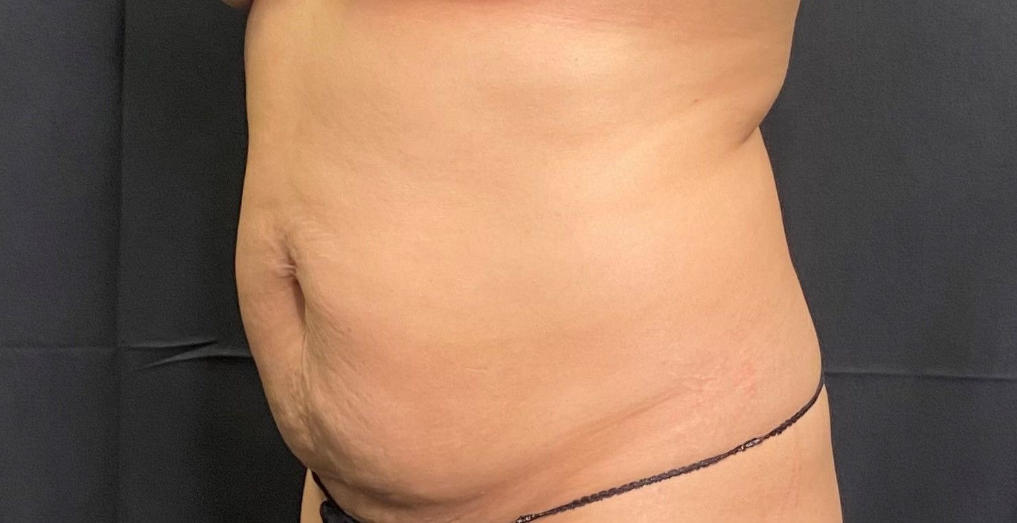 Side view of a woman's stomach is shown with a black background, before laser lipo treatment.