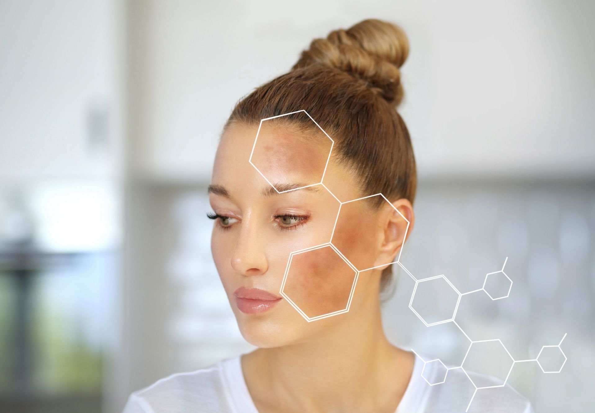 woman with hyperpigmentation on cheeks magnified in hexagonal graphic frame