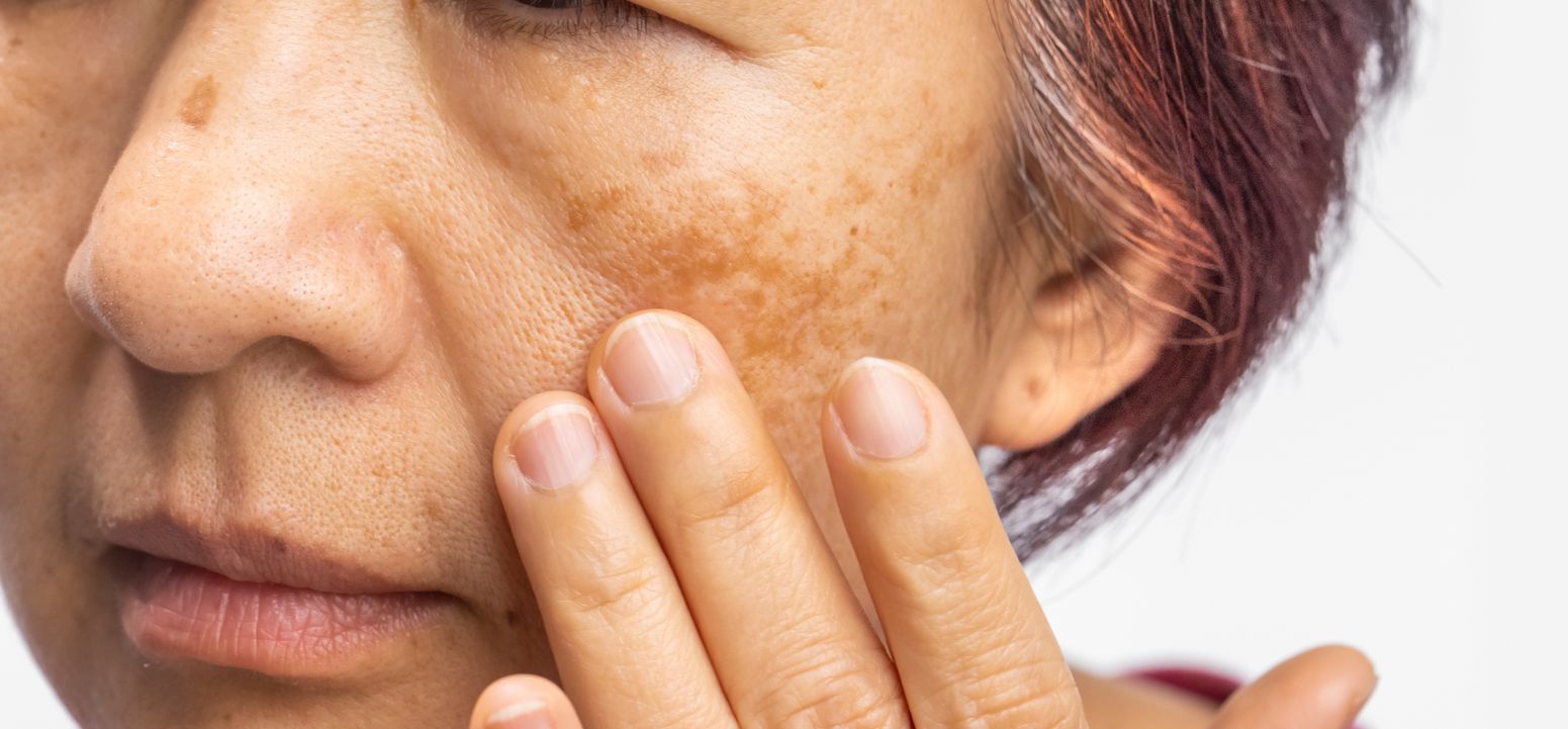 mature woman skincare model showing melasma on cheek