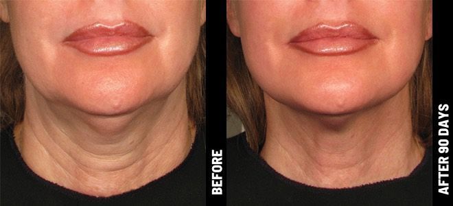 real patient shown before and after treatment with Ultherapy®