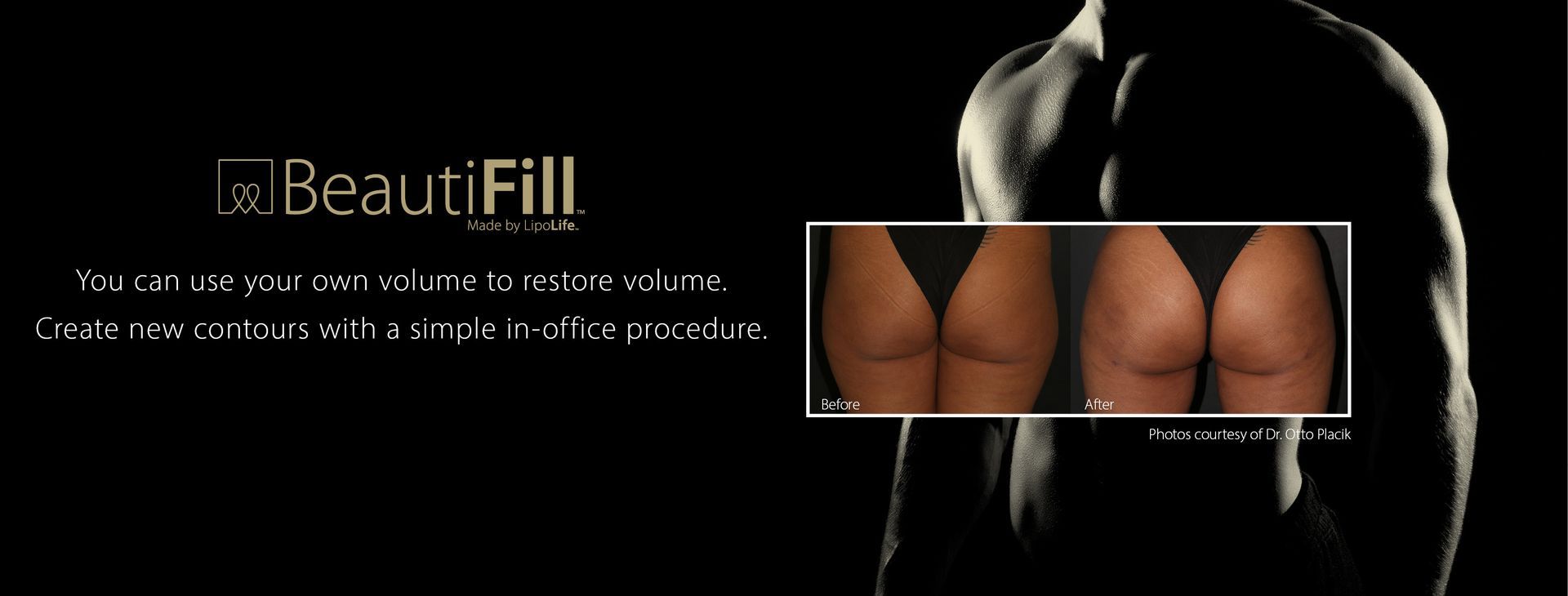 photo of man's muscled torso, with the BeautiFill logo and a before and after photo of a patient's buttocks