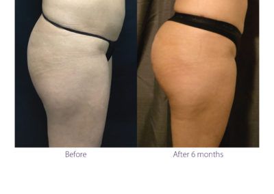 patient's body before and after BeautiFill laser lipo and fat transfer