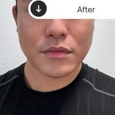 PATIENT PHOTO jaw and chin contouring with radiesse