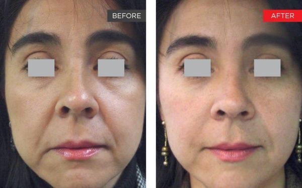 real patient shown before and after treatment with Fotona laser