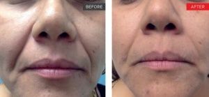 real patient shown before and after treatment with Fotona laser