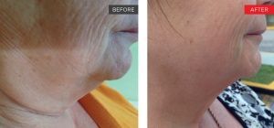 real patient shown before and after treatment with Fotona laser