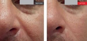 real patient shown before and after treatment with Fotona laser
