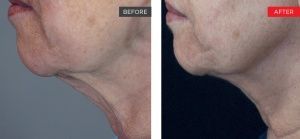 real patient shown before and after treatment with Fotona laser