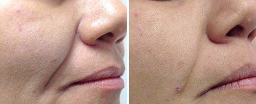 real patient shown before and after treatment with Fotona laser