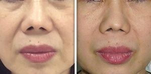 real patient shown before and after treatment with Fotona laser
