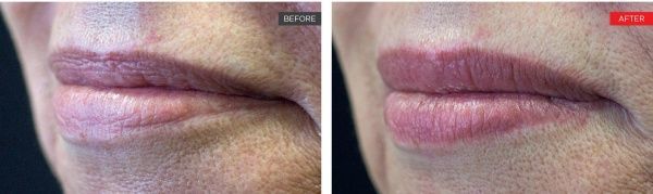 real patient before and after treatment with Fotona laser