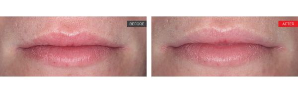 real patient before and after treatment with Fotona laser