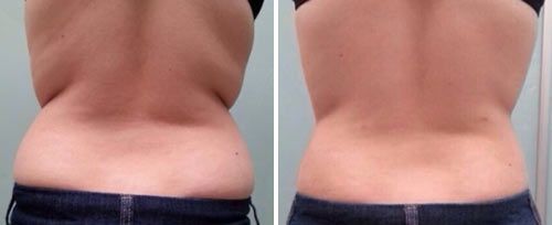 real patient shown before and after treatment with Fotona laser