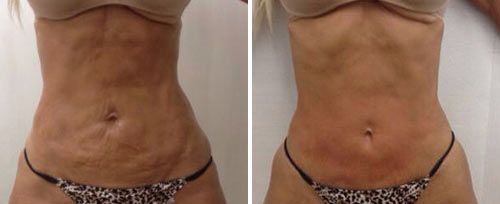 real patient shown before and after treatment with Fotona laser