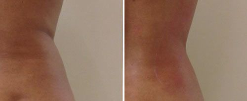 real patient shown before and after treatment with Fotona laser