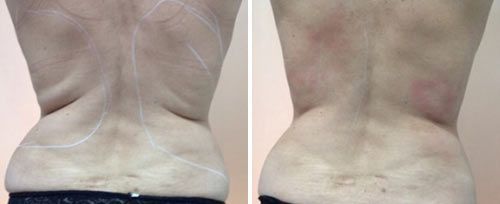 real patient shown before and after treatment with Fotona laser