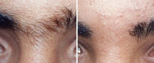 real patient shown before and after treatment with Fotona laser