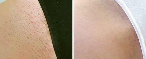 real patient shown before and after treatment with Fotona laser