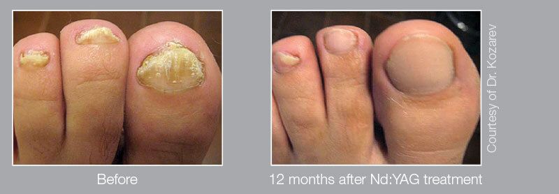 patient before and after treatment with Fotona laser