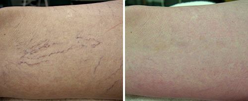 real patient before and after treatment with Fotona laser