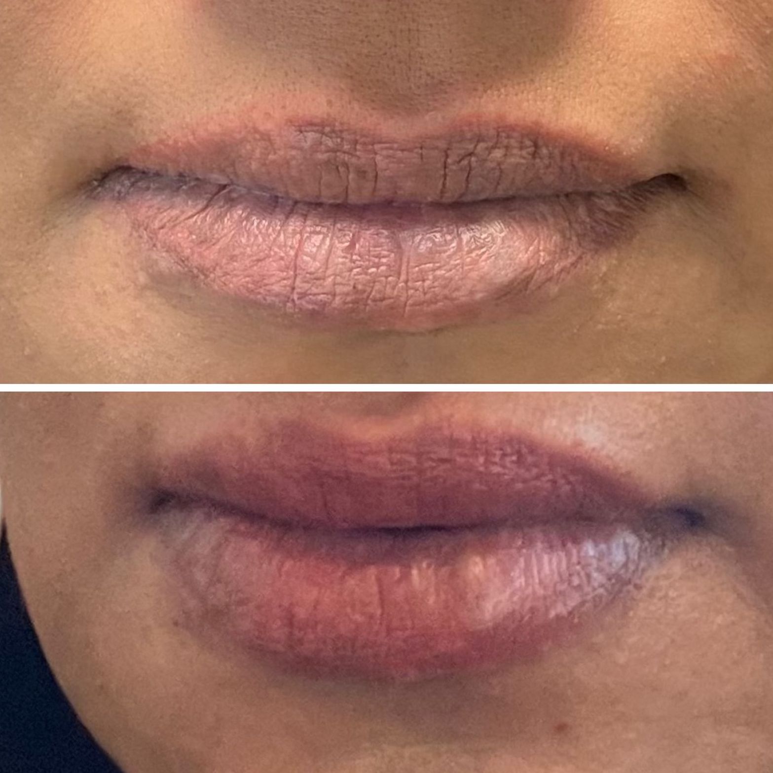 patient photos: before and after lip filler