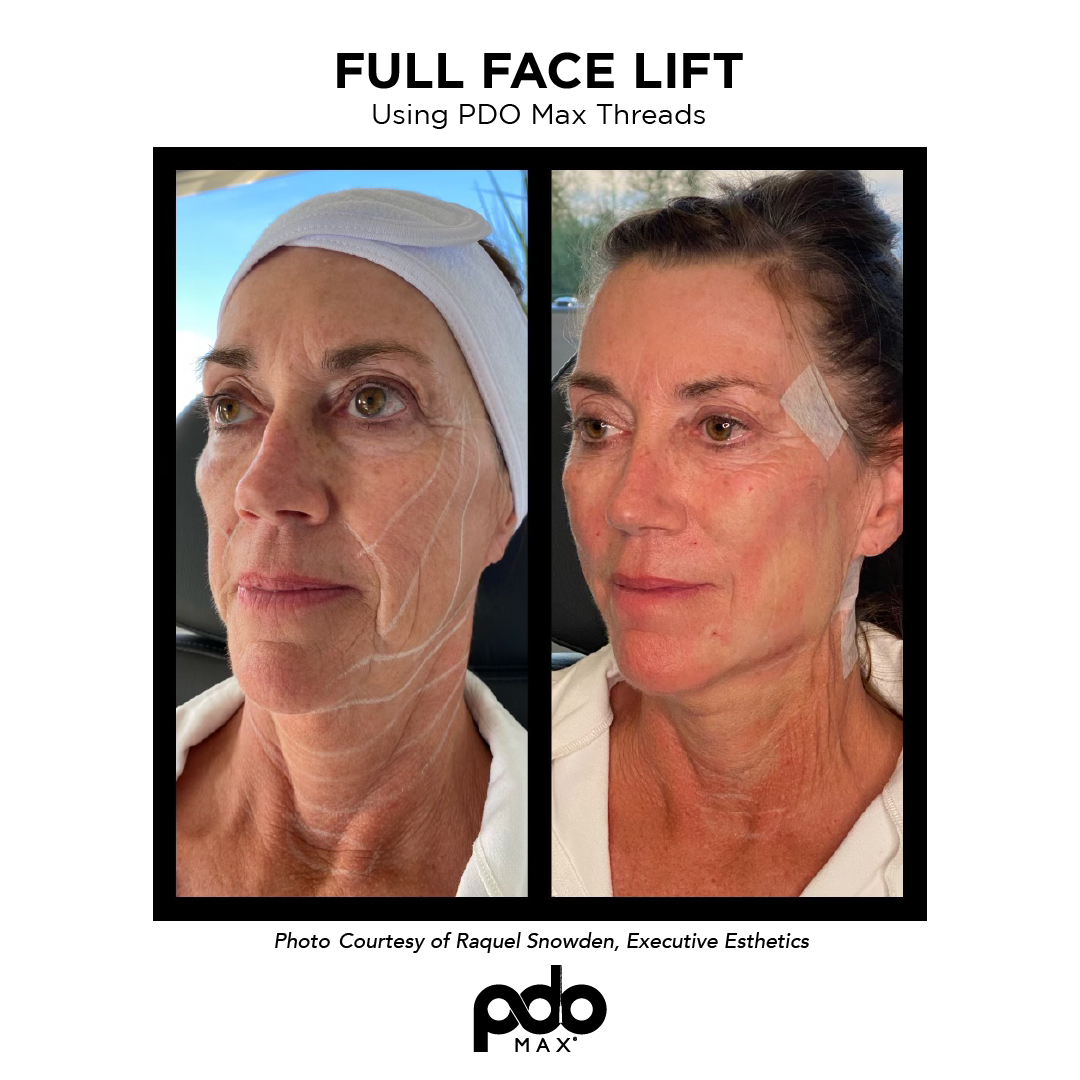 real patient shown before and after treatment with PDO Max threads