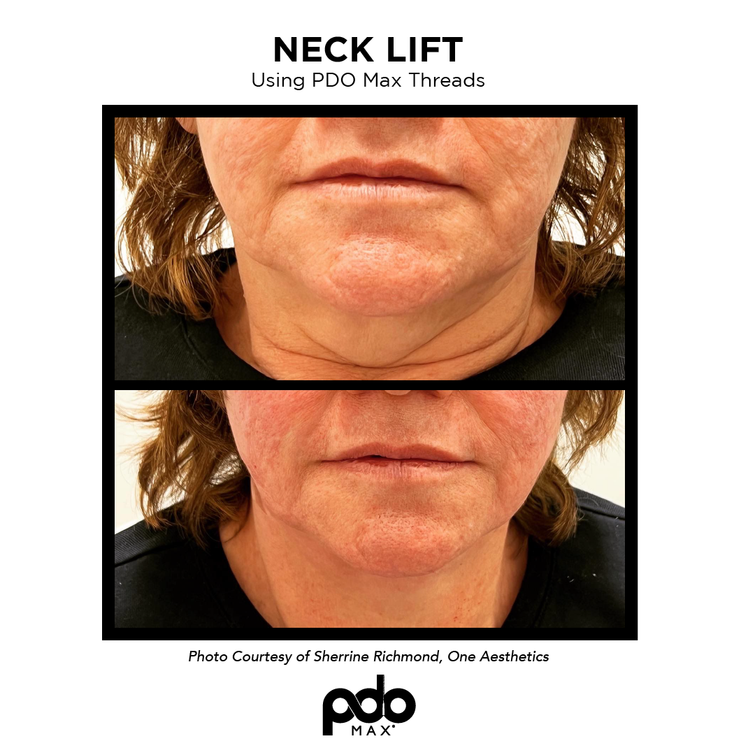 real patient shown before and after treatment with PDO Max threads