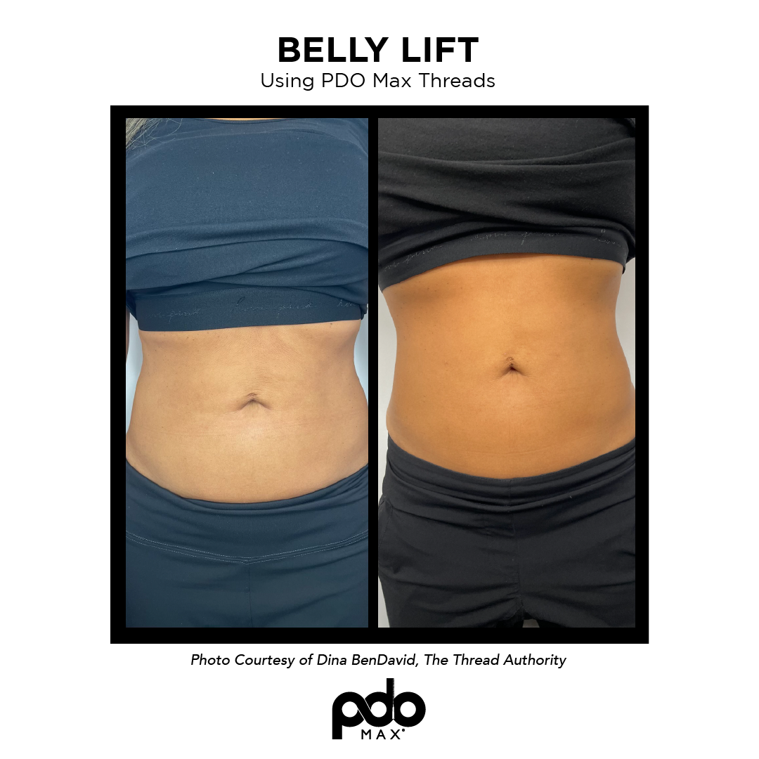 real patient shown before and after treatment with PDO Max threads