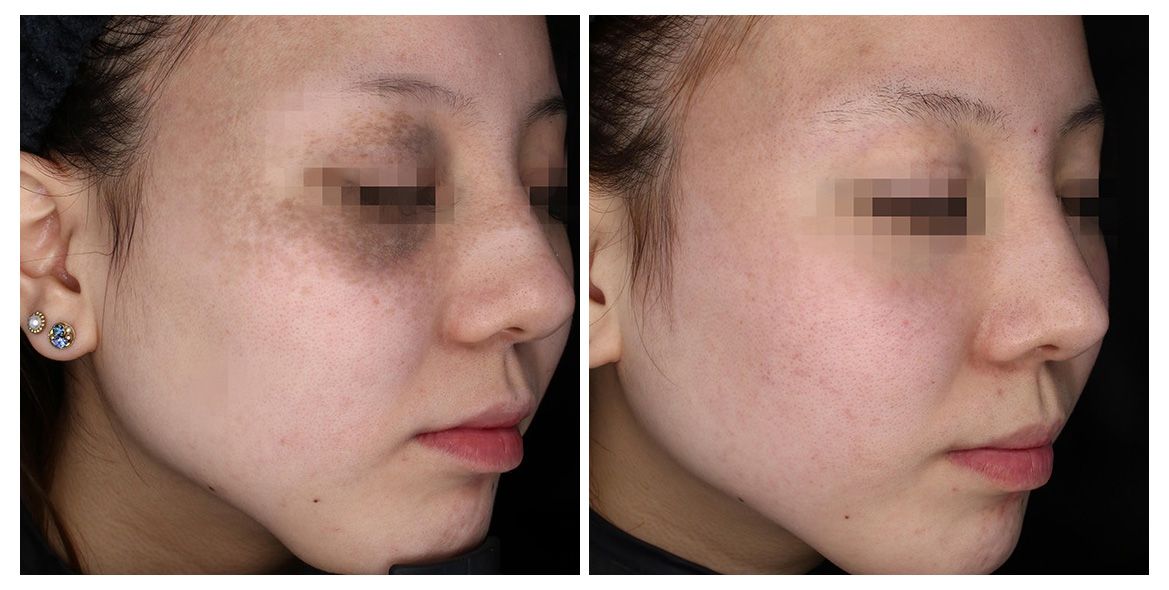 patient before and after treatment with PicoSure Pro laser for melasma and hyperpigmentation