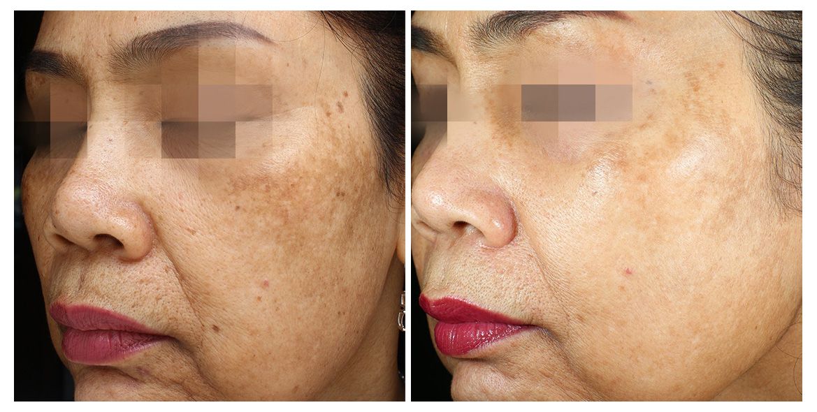 patient before and after treatment with PicoSure Pro laser for melasma and hyperpigmentation