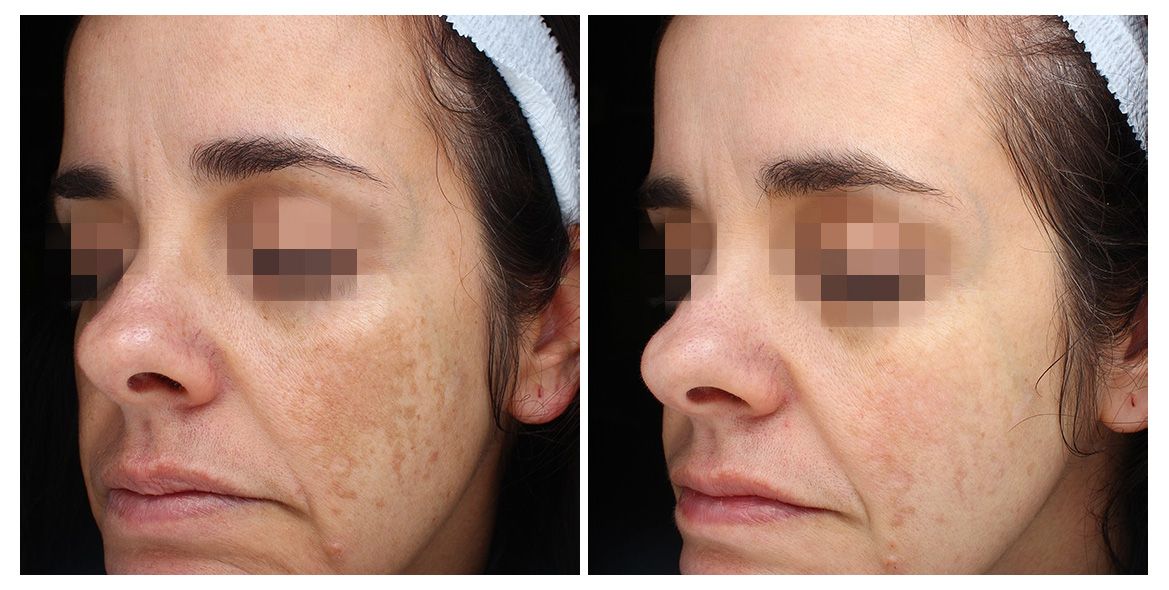 patient before and after treatment with PicoSure Pro laser for melasma and hyperpigmentation
