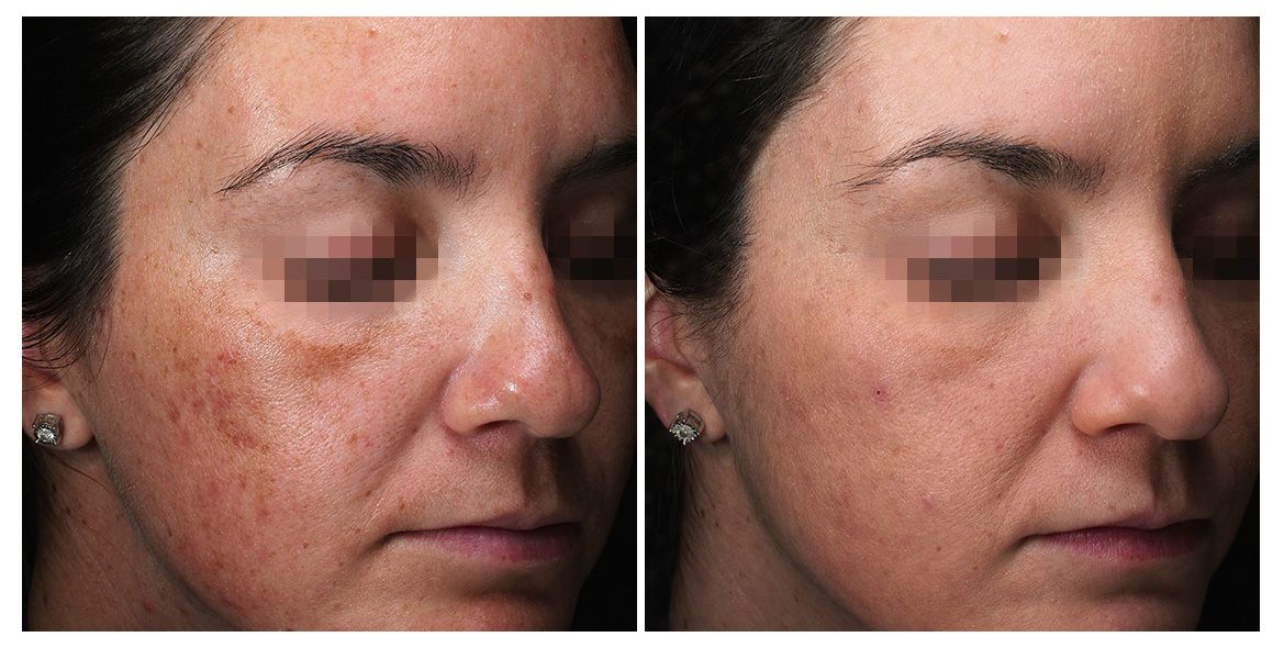 patient before and after treatment with PicoSure Pro laser for melasma and hyperpigmentation