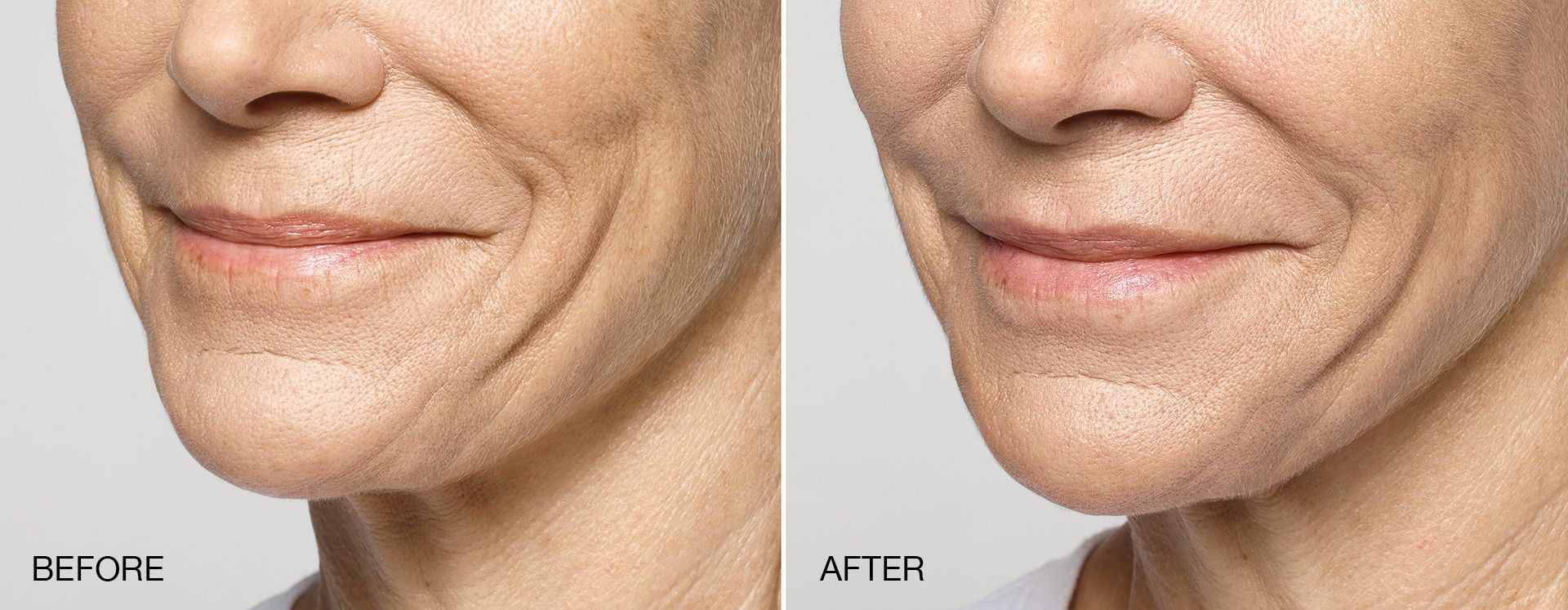 real patient shown before and after treatment with Restylane collection of fillers