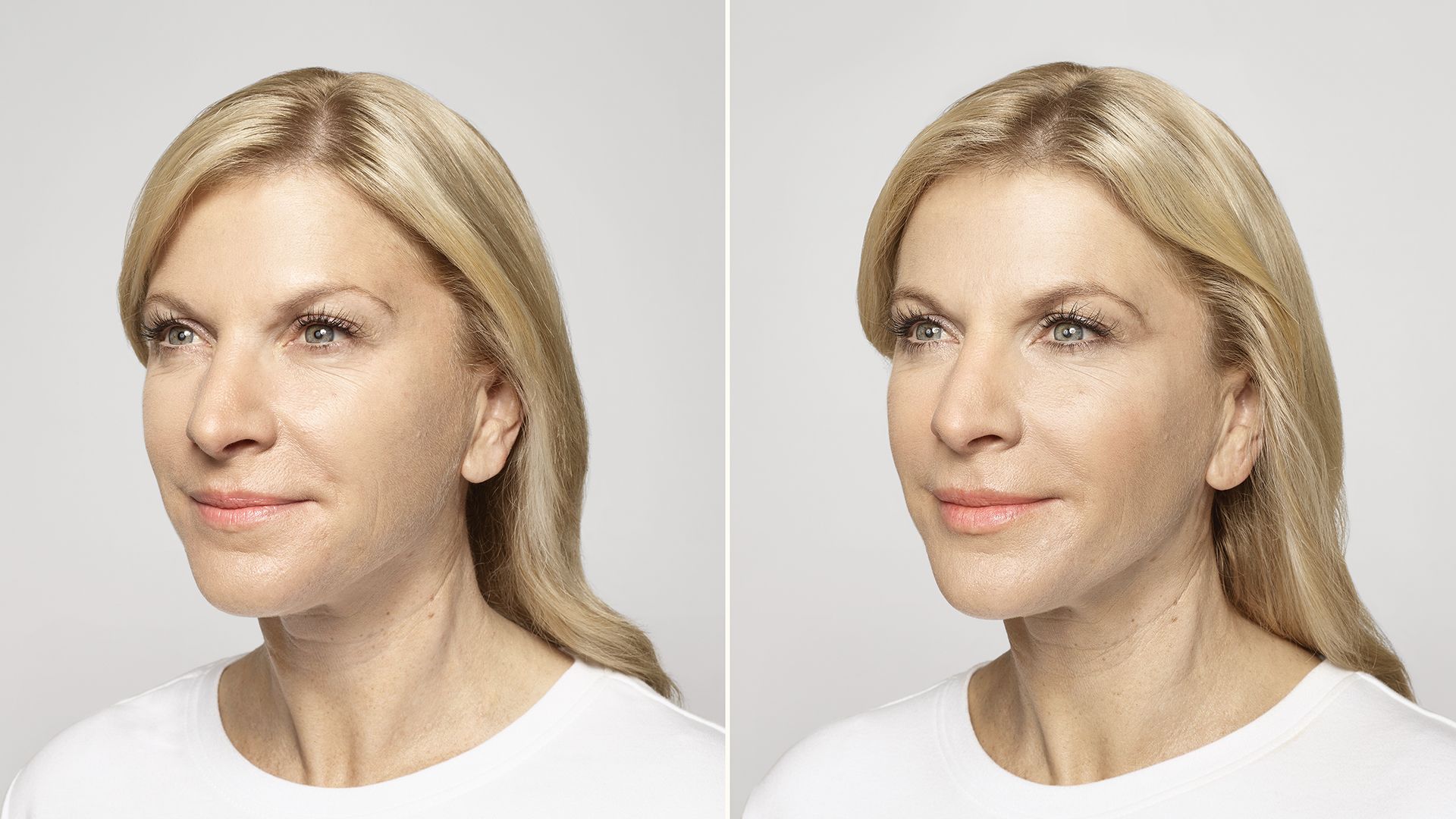 real patient shown before and after treatment with Restylane collection of fillers
