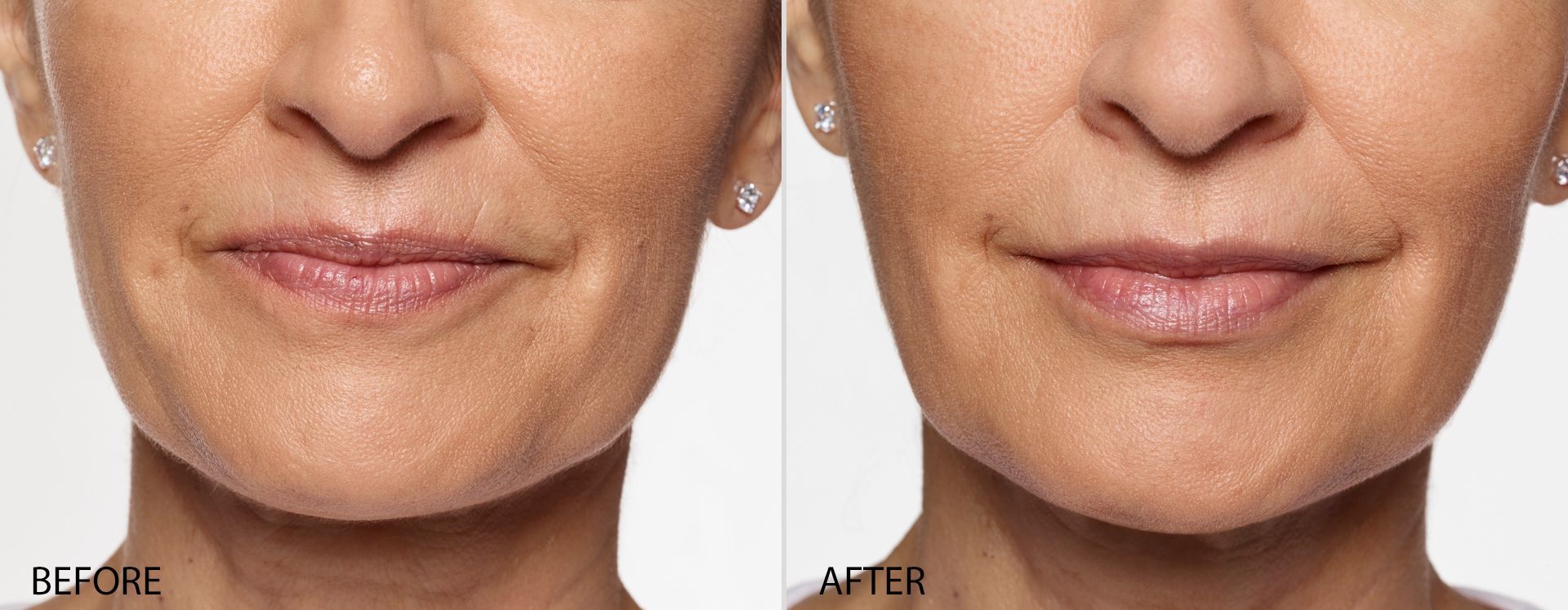 real patient shown before and after treatment with Restylane collection of fillers