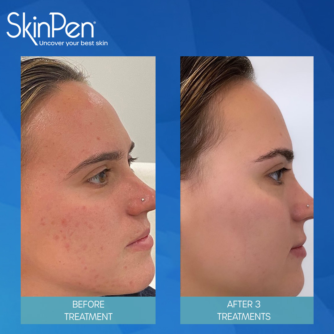 real patient shown before and after treatment with SkinPen®
