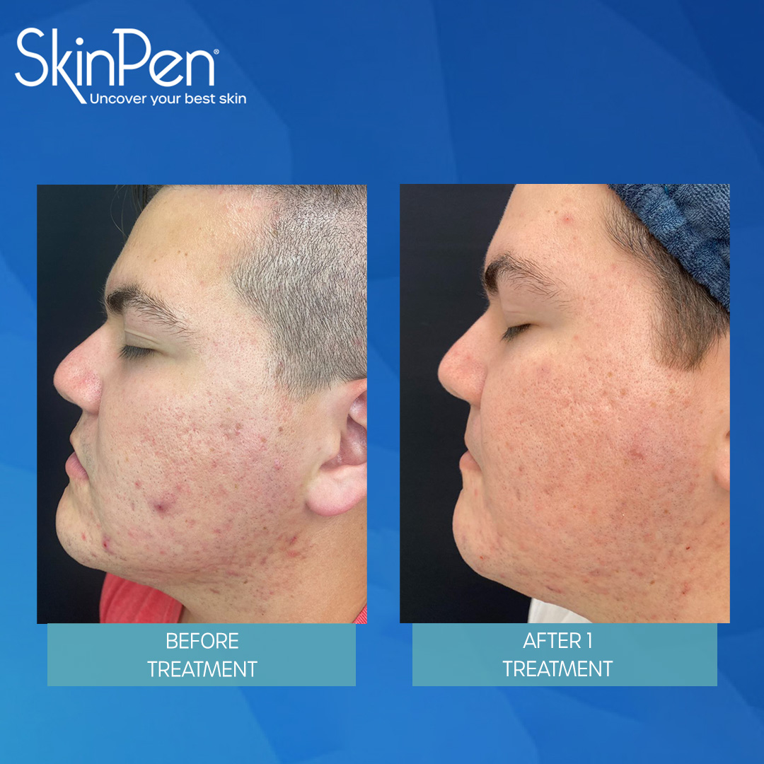 real patient shown before and after treatment with SkinPen®