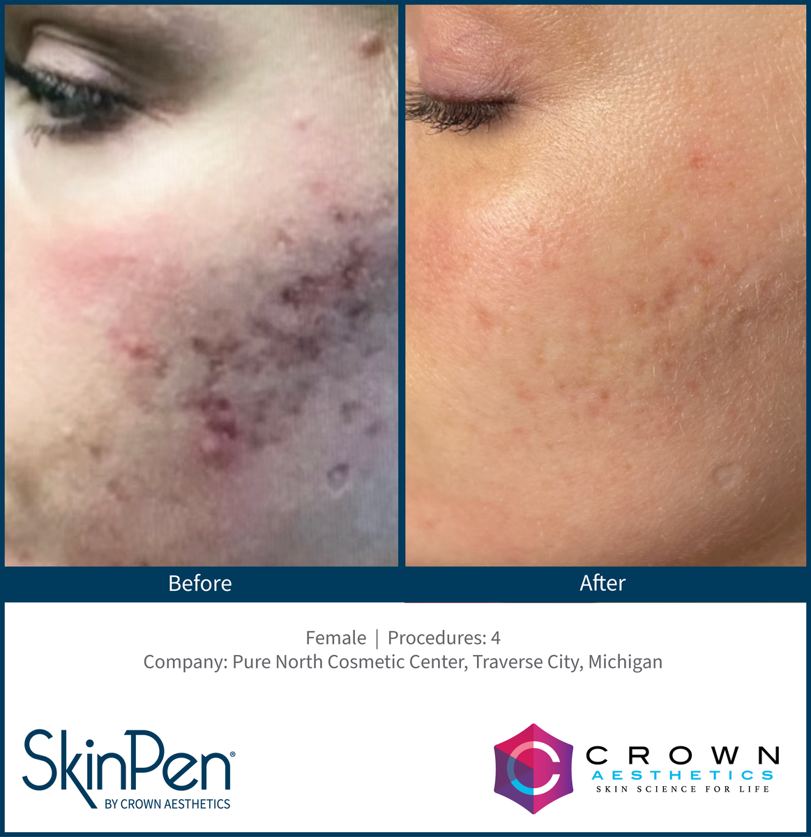 real patient shown before and after treatment with SkinPen®