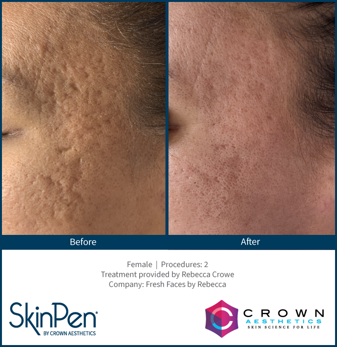 real patient shown before and after treatment with SkinPen®