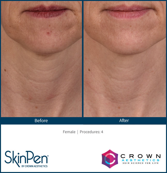 real patient shown before and after treatment with SkinPen®