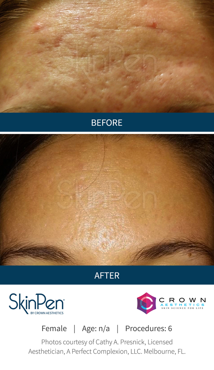 real patient shown before and after treatment with SkinPen®