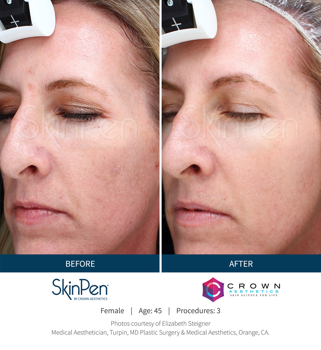real patient shown before and after treatment with SkinPen®