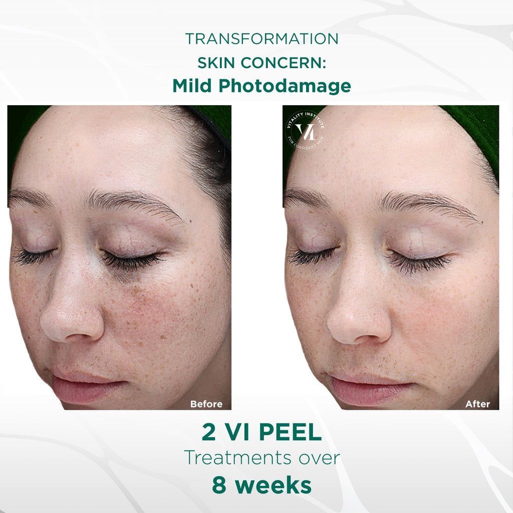 real patient shown before and after treatment with VI Peel