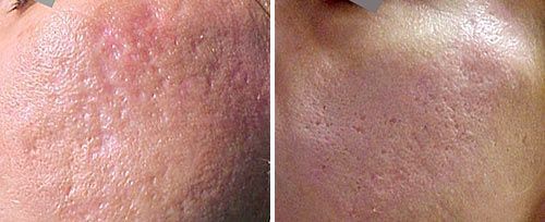 patient before and after treatment with Fotona laser