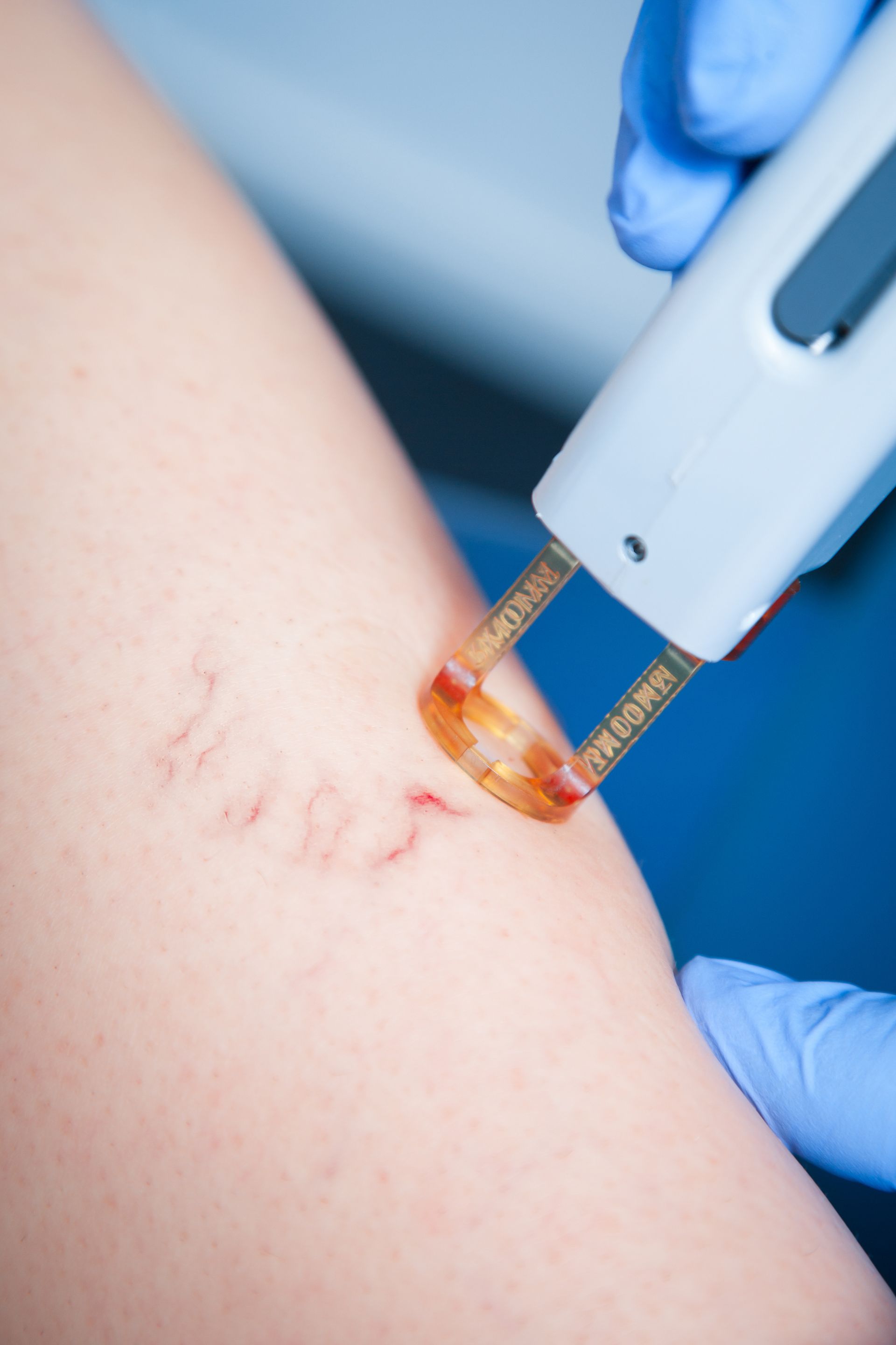 closeup of laser treatment device on female patient's varicose leg veins