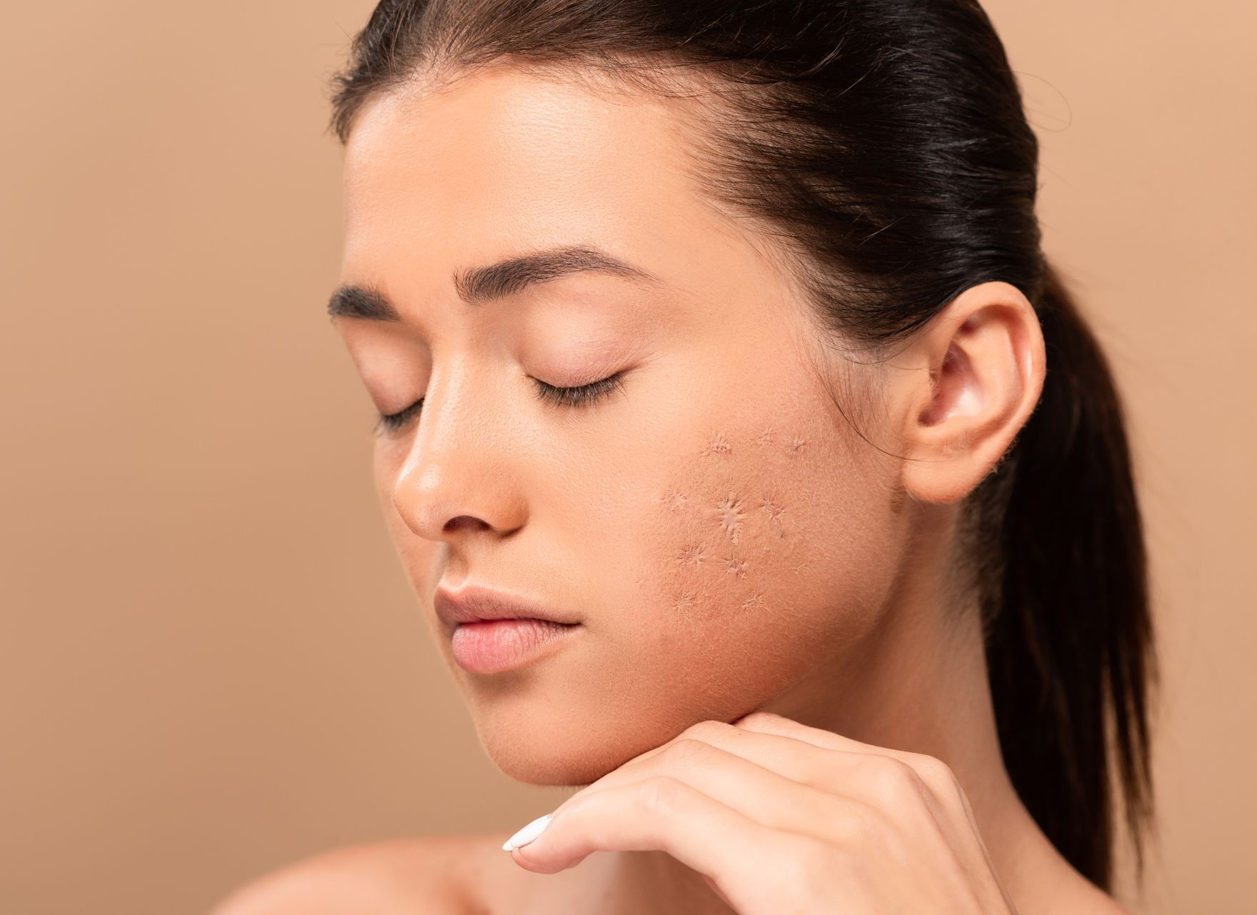 closeup of female model with dark hair and acne scars on tan background