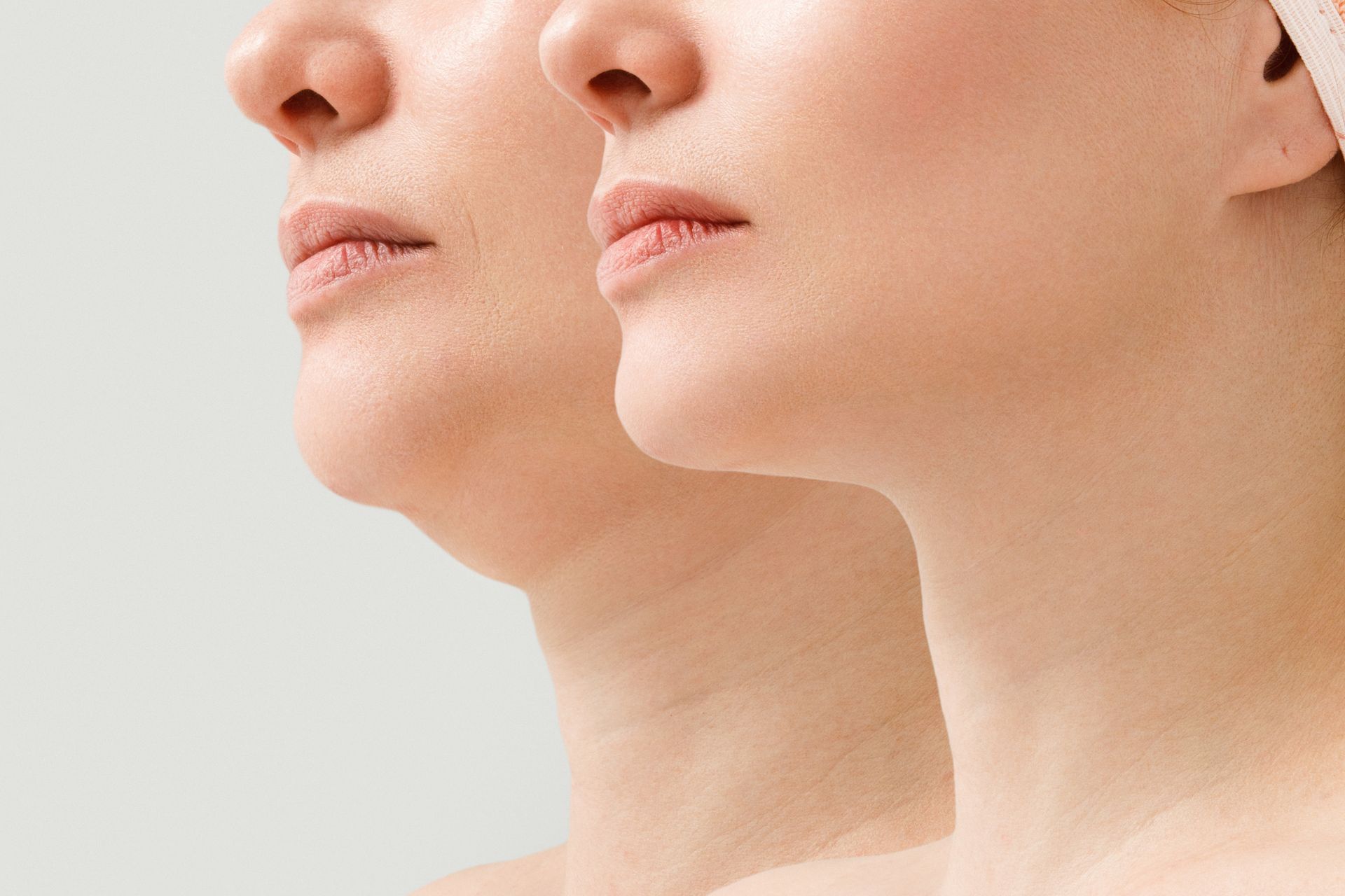 comparison photo of female model before and after double chin reduction treatment