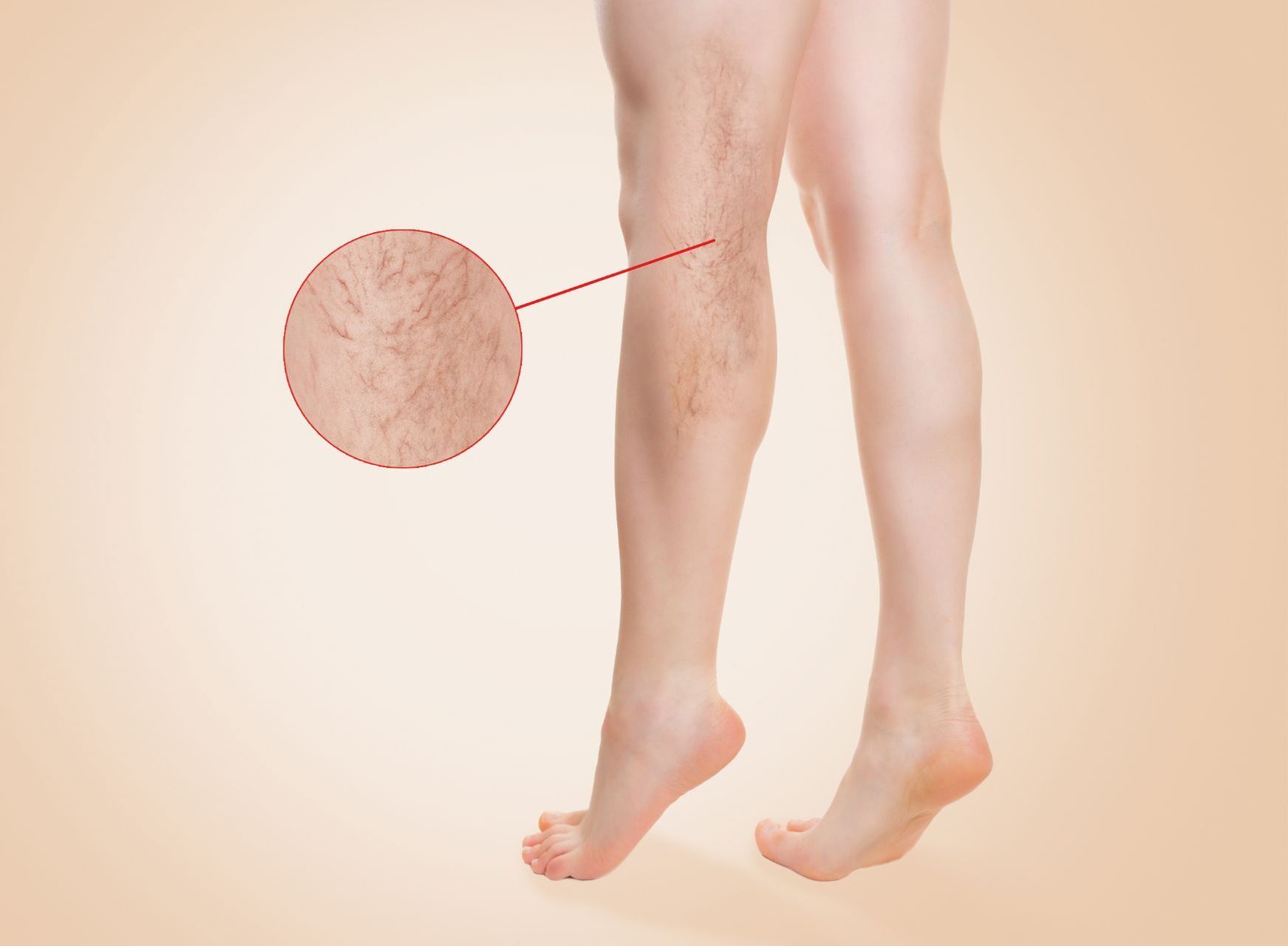 female legs with spider veins