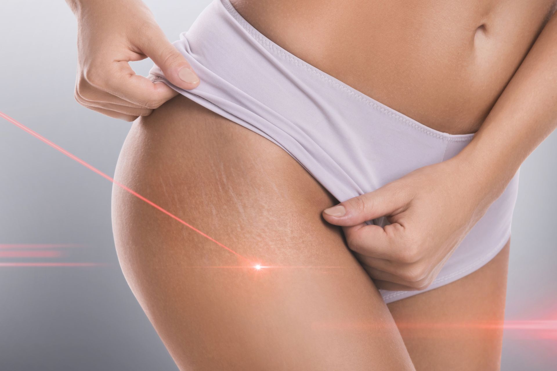 visualization of laser treatment on stretch marks on a woman's upper thigh