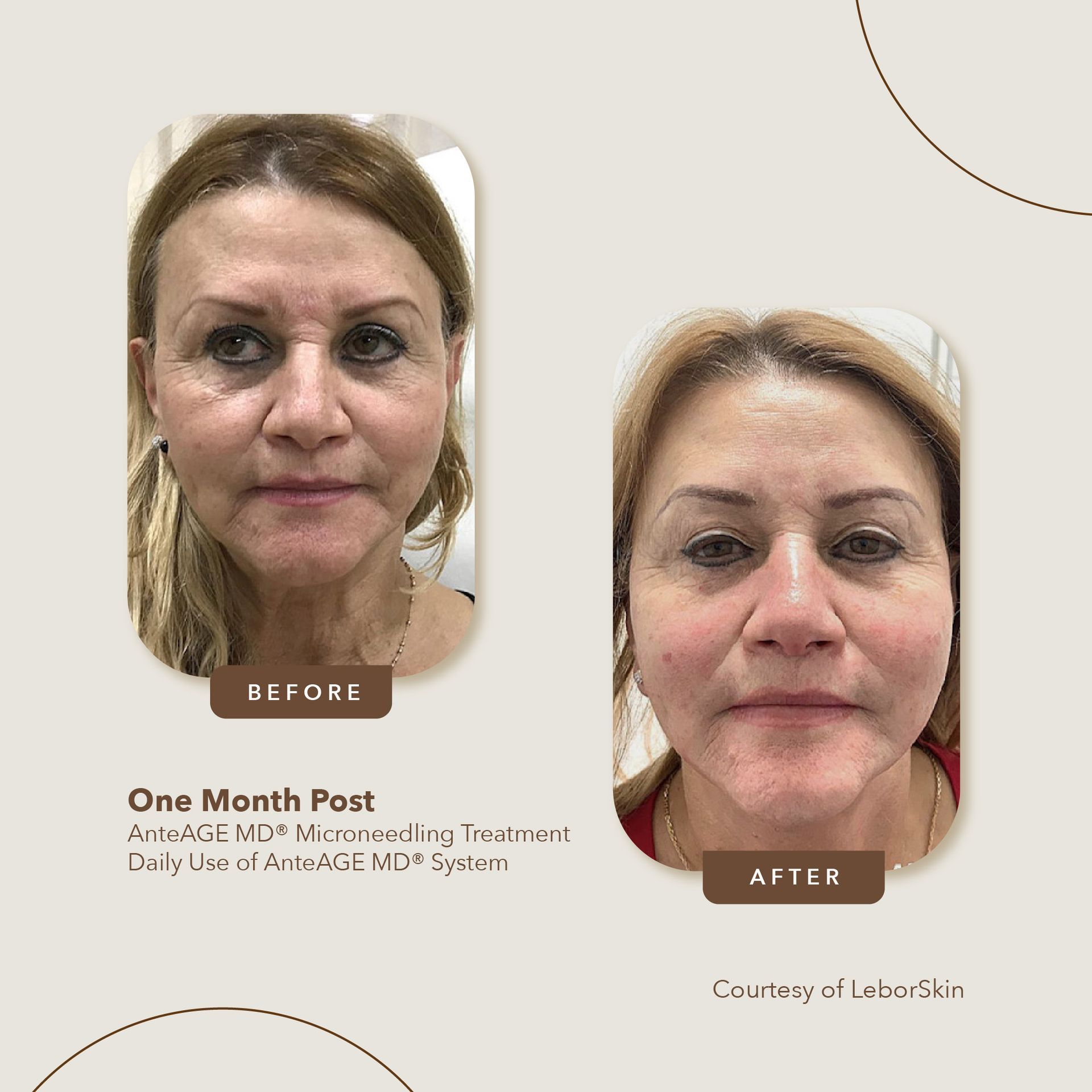 growth factor - before and after photos